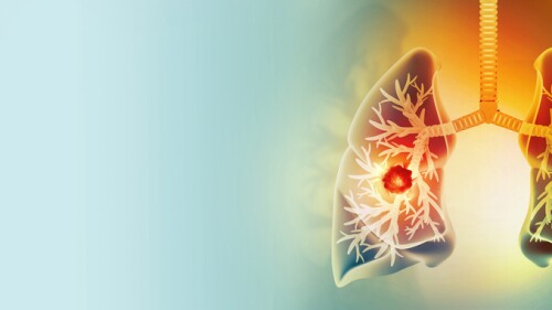 Medically accurate illustration of lung cancer. showing presence of cancerous tumor inside the lungs. 3d illustration