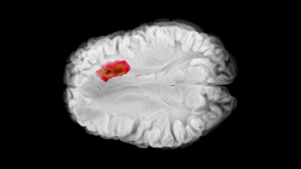Axial view of the brain showing a glioblastoma in the left frontal lobe with central necrosis, peripheral infiltration, and early midline shift.